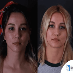 lip-lift-female-in-turkey