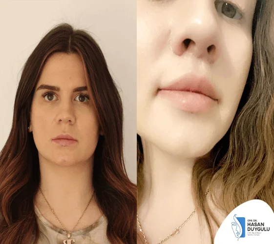 lip-lift-turkey-with-dr-hasan-duygulu