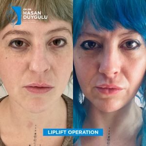 lifting-delle-labbra-donna-in-turchia