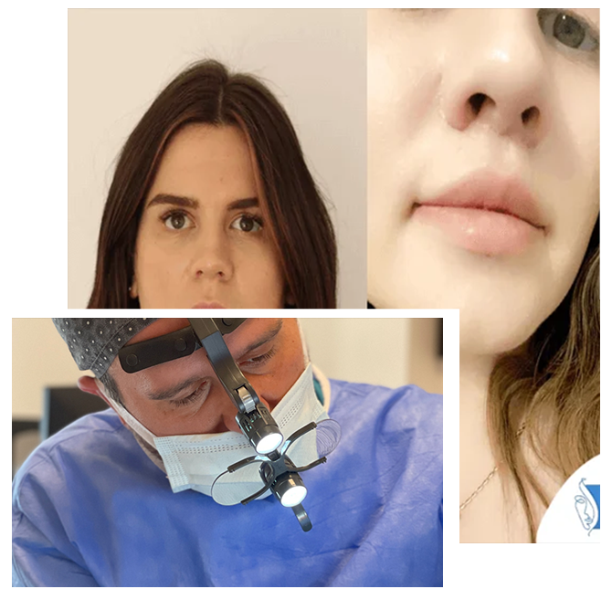 Lip lift Turchia