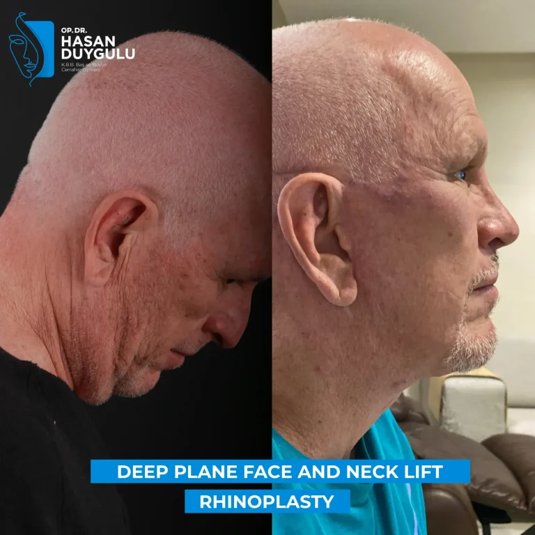 male-face-and-neck-lift-turkey-photos-faceaesthetics
