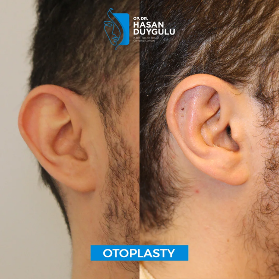 otoplasty-surgery-istanbul-with-dr-hasan-duygulu