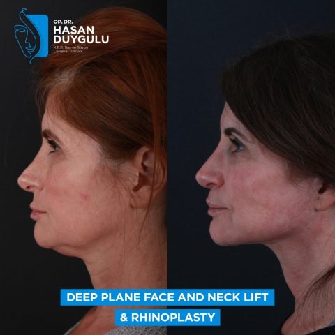 lifting profondo del viso per donne