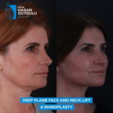 Lifting profondo del viso e del collo