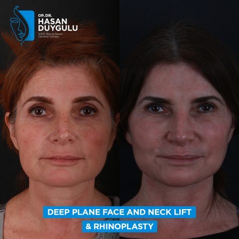 rinoplastica prima dopo donna