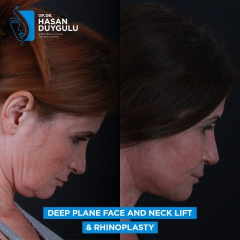 lifting del collo femminile prima dopo