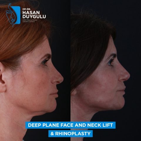 lifting del collo femminile in Turchia