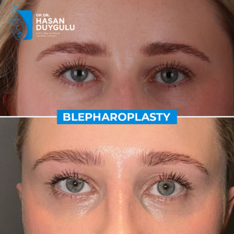 blefaroplastica-turchia-con-il-dott-hasan-duygulu