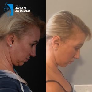 Foto di lifting prima e dopo in Turchia