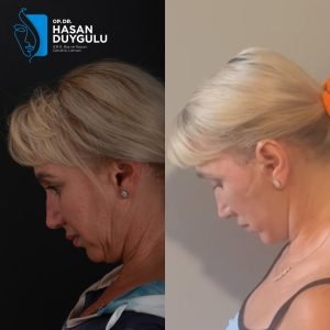 Lifting viso per donne prima e dopo in Turchia