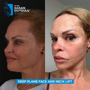 lifting-facciale-donne-turchia