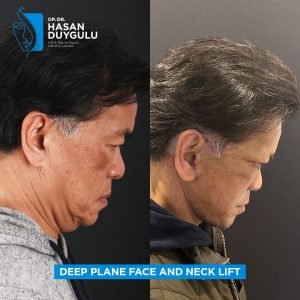 Foto prima e dopo del lifting facciale in Turchia