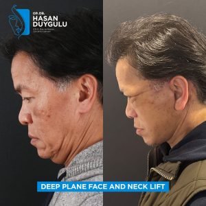 Foto prima e dopo del lifting facciale in Turchia