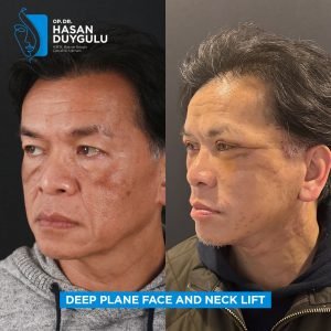 Foto prima e dopo del lifting facciale in Turchia