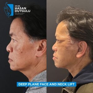 Foto prima e dopo del lifting facciale in Turchia