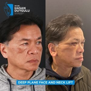 Foto prima e dopo del lifting facciale in Turchia