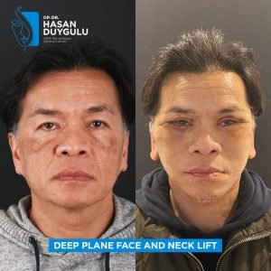 Foto prima e dopo del lifting facciale in Turchia