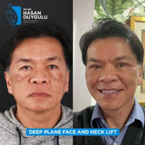 Foto prima e dopo del lifting facciale in Turchia
