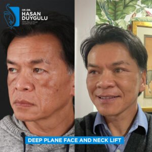 Foto prima e dopo del lifting facciale in Turchia