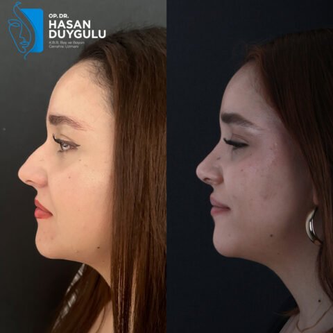 rinoplastica-faceaesthetics