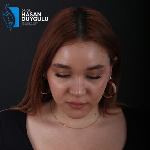 rinoplastica-istanbul-faceaesthetics