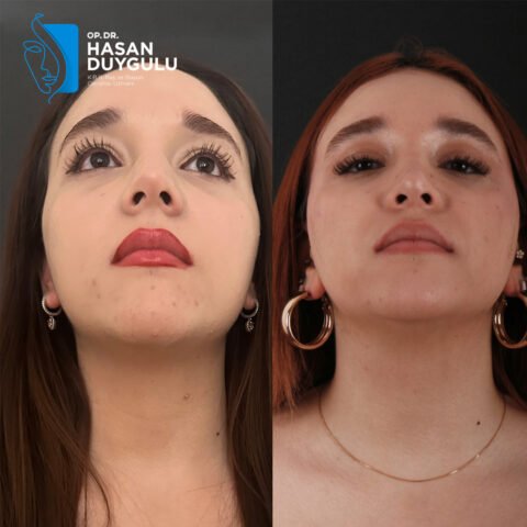 rinoplastica-turchia-faceaesthetics