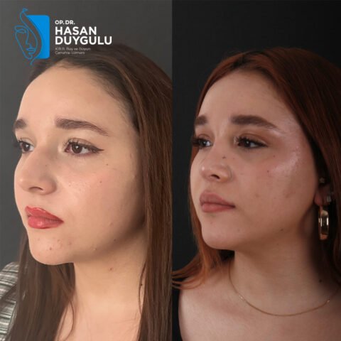 rinoplastica-turchia-istanbul