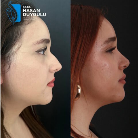 chirurgia-rinoplastica-turchia