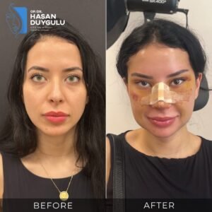 Foto prima e dopo l'intervento agli occhi a mandorla in Turchia