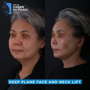 chirurgia-deep-plane-e-lifting-del-collo-Turchia