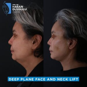 Foto prima e dopo del lifting facciale in Turchia