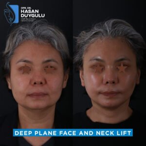 Foto prima e dopo del lifting facciale in Turchia