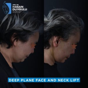 Foto prima e dopo del lifting facciale in Turchia