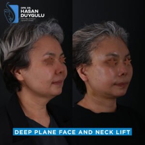 Foto prima e dopo del lifting facciale in Turchia