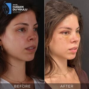 Foto prima e dopo del lifting facciale in Turchia