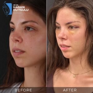 Foto prima e dopo del lifting facciale in Turchia
