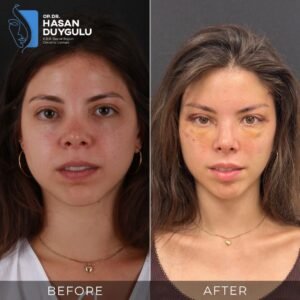 Foto prima e dopo del lifting facciale in Turchia