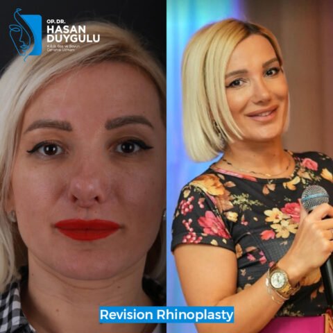 rinoplastica-chirurgia-plastica