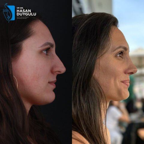 chirurgo-rinoplastico-in-turchia