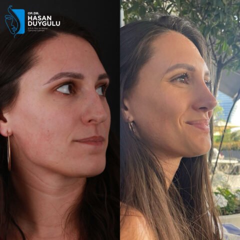 intervento-di-rinoplastica-turchia