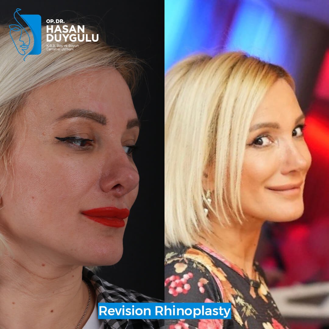 intervento-di-rinoplastica-turchia-istanbul