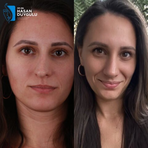 intervento-di-rinoplastica-turchia-istanbul
