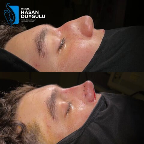 rinoplastica-turchia