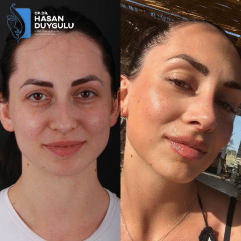 intervento-di-rinoplastica