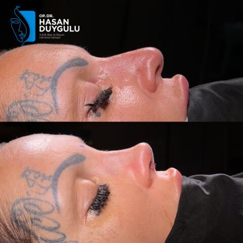 rinoplastica-intervento-4