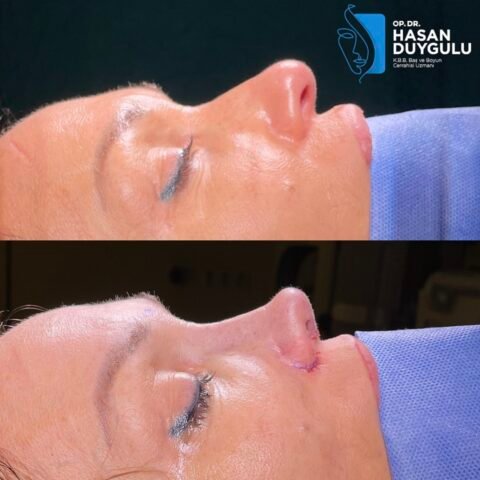 chirurgo-rinoplastico-turchia