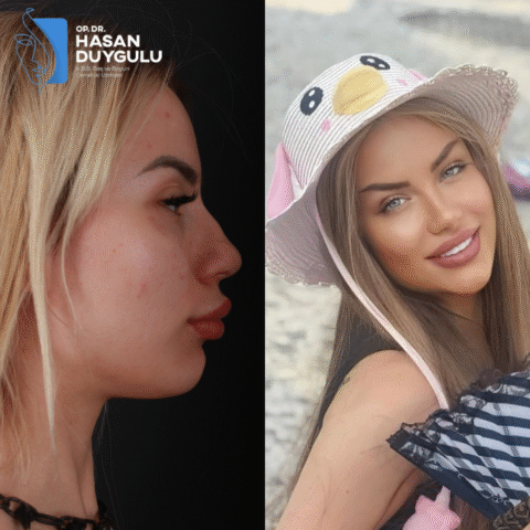 intervento-di-rinoplastica