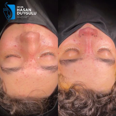 intervento-di-rinoplastica-in-turchia