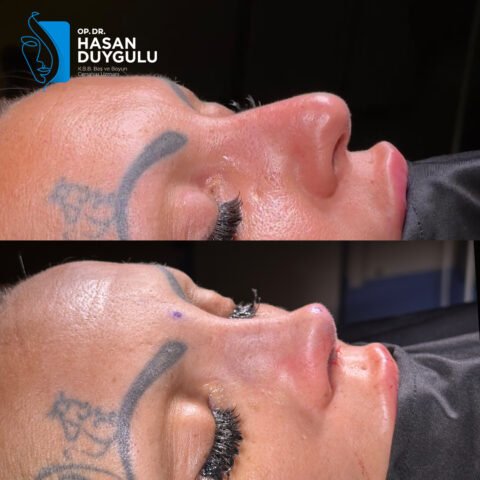 rinoplastica-intervento-3